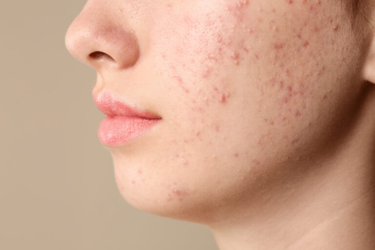 Acne comedonica im Gesicht