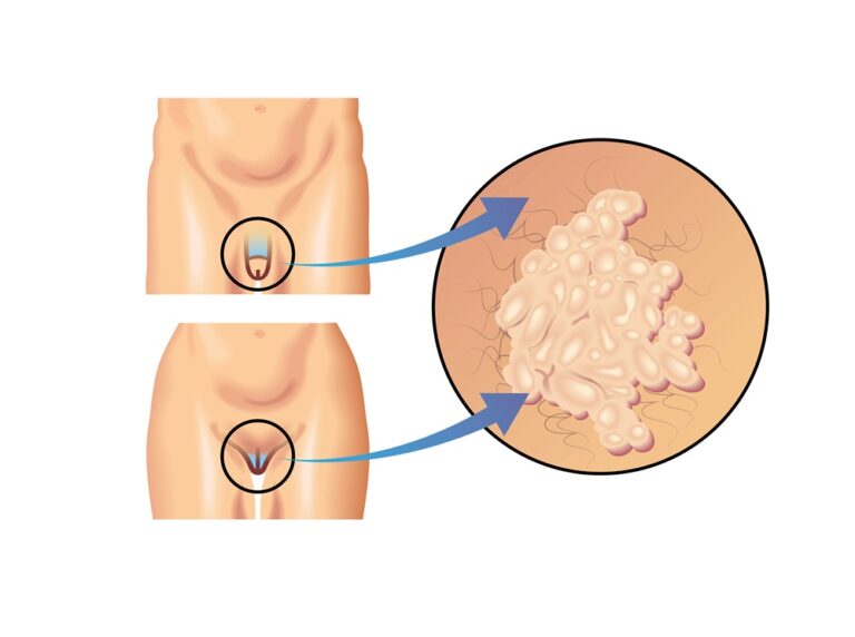 Feiwarze im Genitalbereich