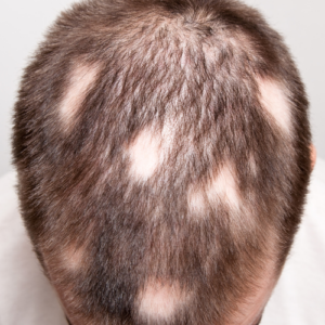 Wunderschne Kreisrunder Haarausfall Schilddrse Bild