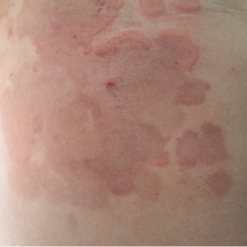 Erythema+nodosum