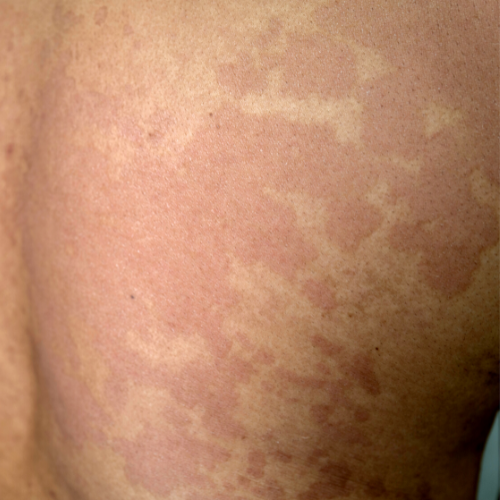 Kleienpilzflechte+(Pityriasis+versicolor)