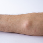 Lipom Ursachen, Symptome & wirksame Behandlung
