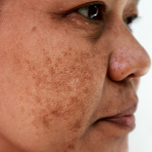 Melasma