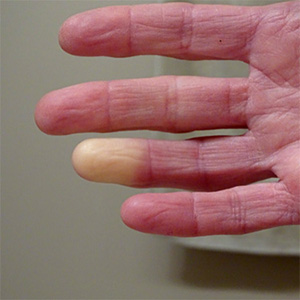 Raynaud-Syndrom