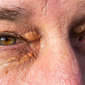 Xanthelasma